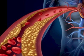 3 أمور تقتل الكوليسترول في الجسم