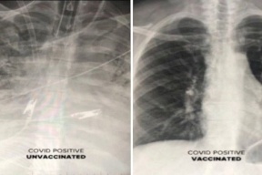 صور بالأشعة السينية تظهر الفرق بين الرئتين قبل وبعد اللقاح