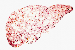 علامة تحذير في بطنك قد تدل على مرض الكبد الدهني!