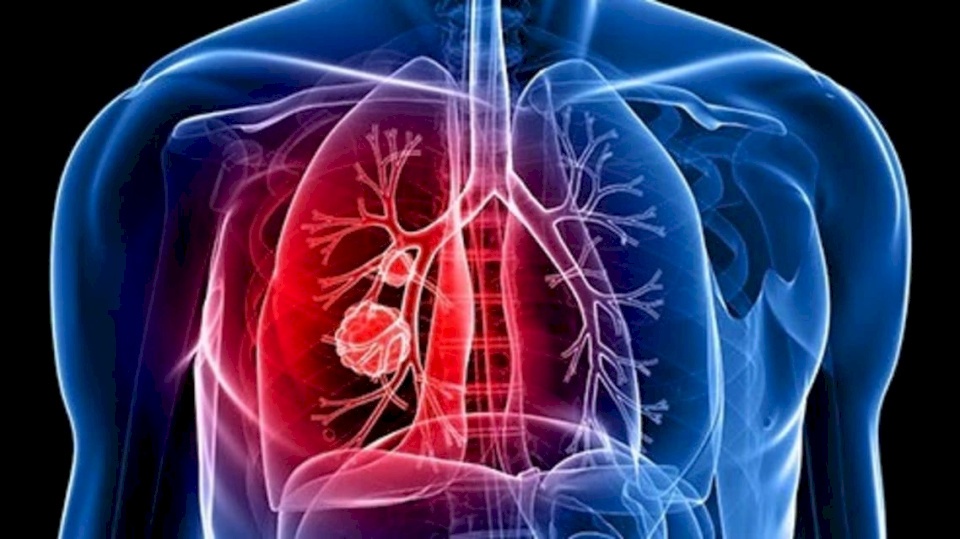 14 علامة غير متوقعة على احتمال الإصابة بسرطان الرئة