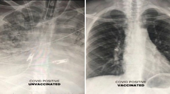 صور بالأشعة السينية تظهر الفرق بين الرئتين قبل وبعد اللقاح