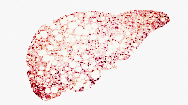 علامة تحذير في بطنك قد تدل على مرض الكبد الدهني!